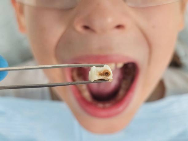 Best Emergency Dentist for Lost Fillings or Crowns in Security Widefield, CO
