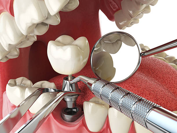 Best Broken or Cracked Tooth Emergency Dentist in Security Widefield, CO